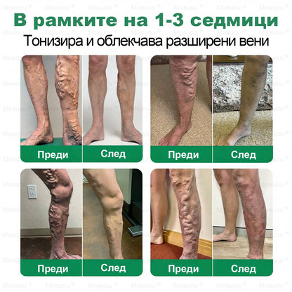 👨‍⚕️✅✅Moauou® Микроиглен пластир за таргетирано действие при разширени вени ⚡Незабавно облекчение, дълготраен ефект — специална промоция